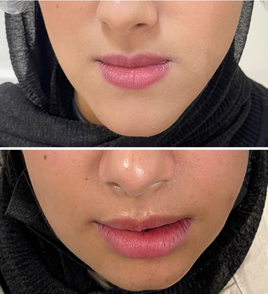 تجميل الوجه والشفاه