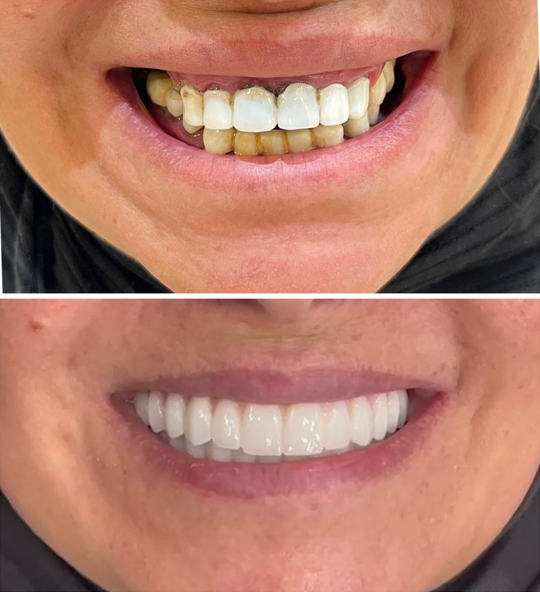 تجميل الابتسامة وتبييض